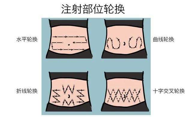 图解胰岛素正确注射方式,快收藏