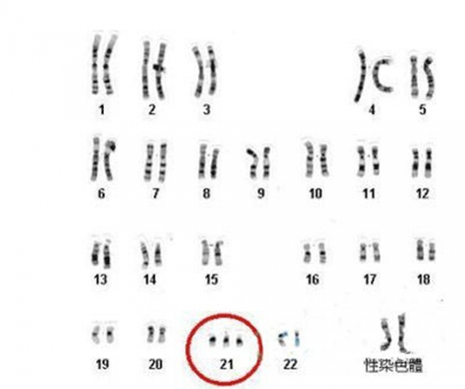 为啥"唐氏儿"小时候长得不一样,长大后都差不多?视觉上的错觉