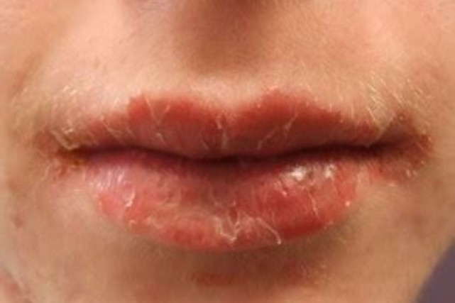 慢性唇炎|嘴唇|细菌感染|牙齿