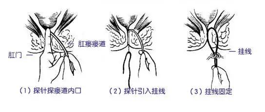 肛瘘能否彻底治愈一定需要手术吗