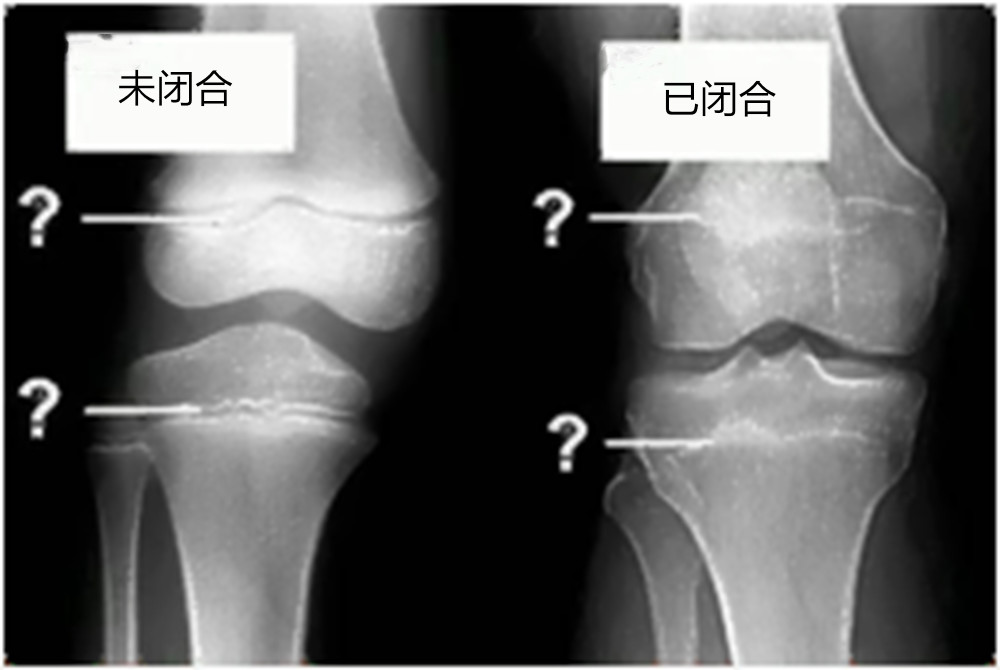 三种信号提示孩子骨骼线即将闭合,父母及时发现,及时补救很重要