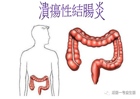 溃疡性结肠跟肠炎有什么区别?该如何调理溃疡性结肠炎?