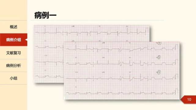 "正后壁"心肌梗死的心电图线索