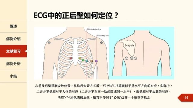 "正后壁"心肌梗死的心电图线索