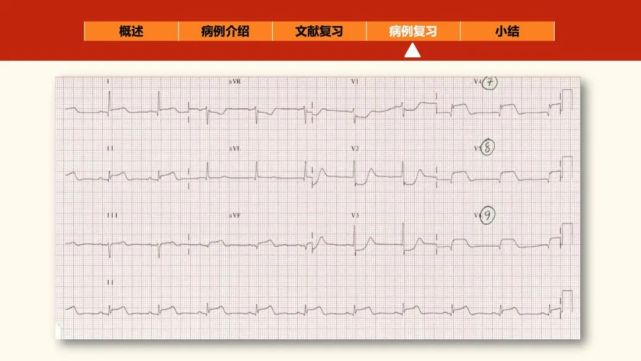 "正后壁"心肌梗死的心电图线索