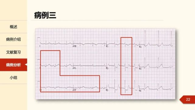 "正后壁"心肌梗死的心电图线索