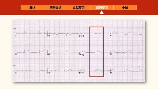 "正后壁"心肌梗死的心电图线索