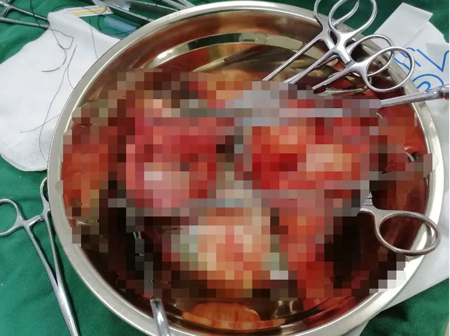 20片卫生巾均浸透,经血增多汹涌而来!