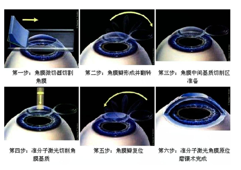 近视激光手术对眼睛有损害吗?