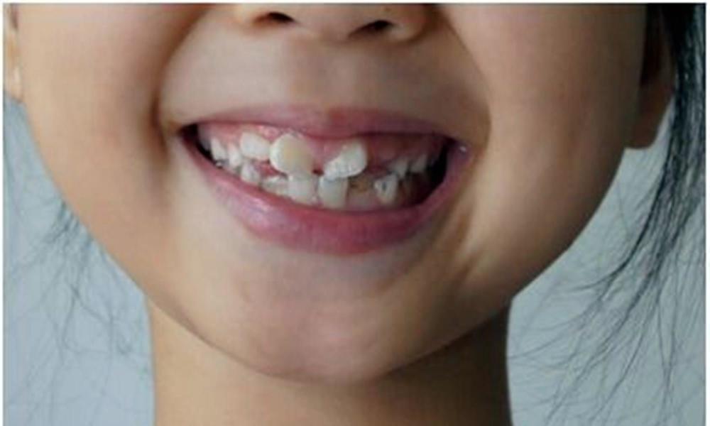 不想孩子满嘴龋齿长"小黑牙",就别让娃自己刷牙,毫无保护效果