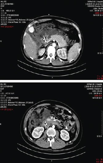 入院后复查腹部ct提示急性坏死性胰腺炎