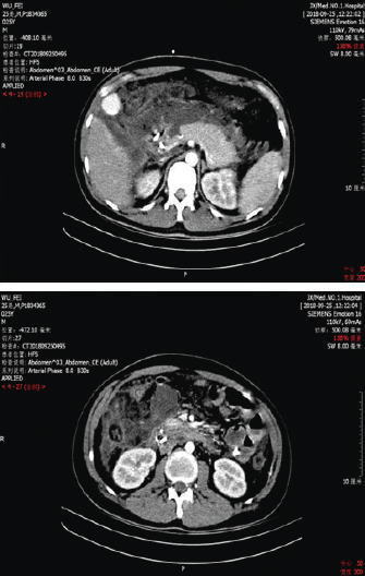 病例分享|重症急性胰腺炎感染 腹腔出血及肠瘘多学科诊治病例分享