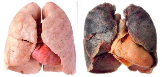 抽烟为什么肺会变黑?戒烟以后,黑色是否还能恢复粉色吗
