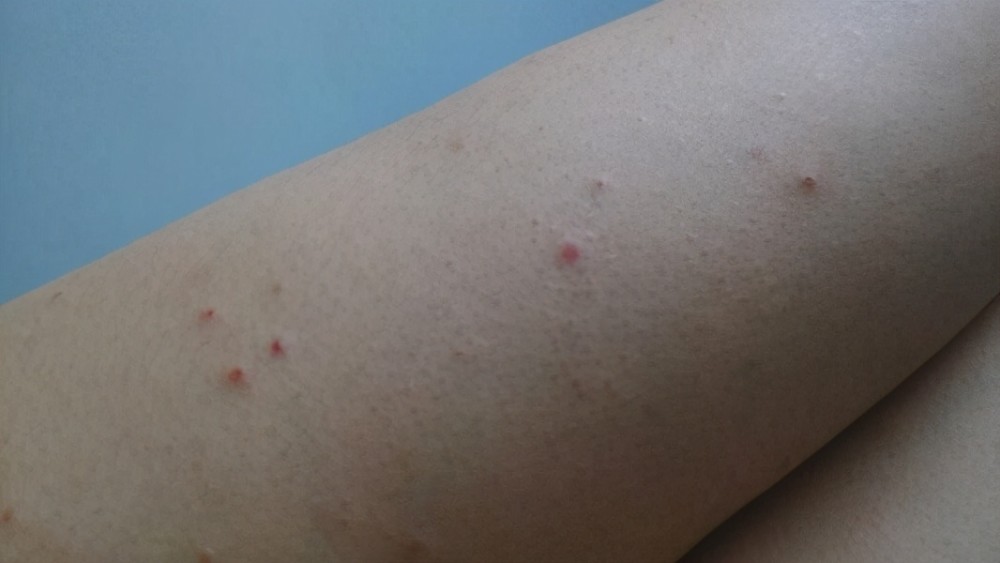 身上有小红点,说明肝脏出大毛病了?辟谣:这2种情况才需要注意