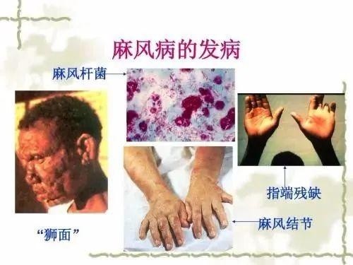 【科普】麻风病很可怕?一文带你读懂它