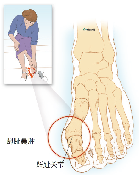 疼痛解剖学|趾囊肿疼痛|第一跖趾关节|内脏|囊肿