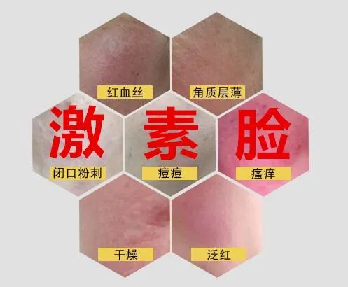 赵桂荣皮肤光电治疗激素依赖性皮炎激素脸有效吗