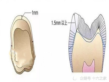 要进行牙体预备,靠近牙龈的地方所均匀磨出的一圈平台称肩台