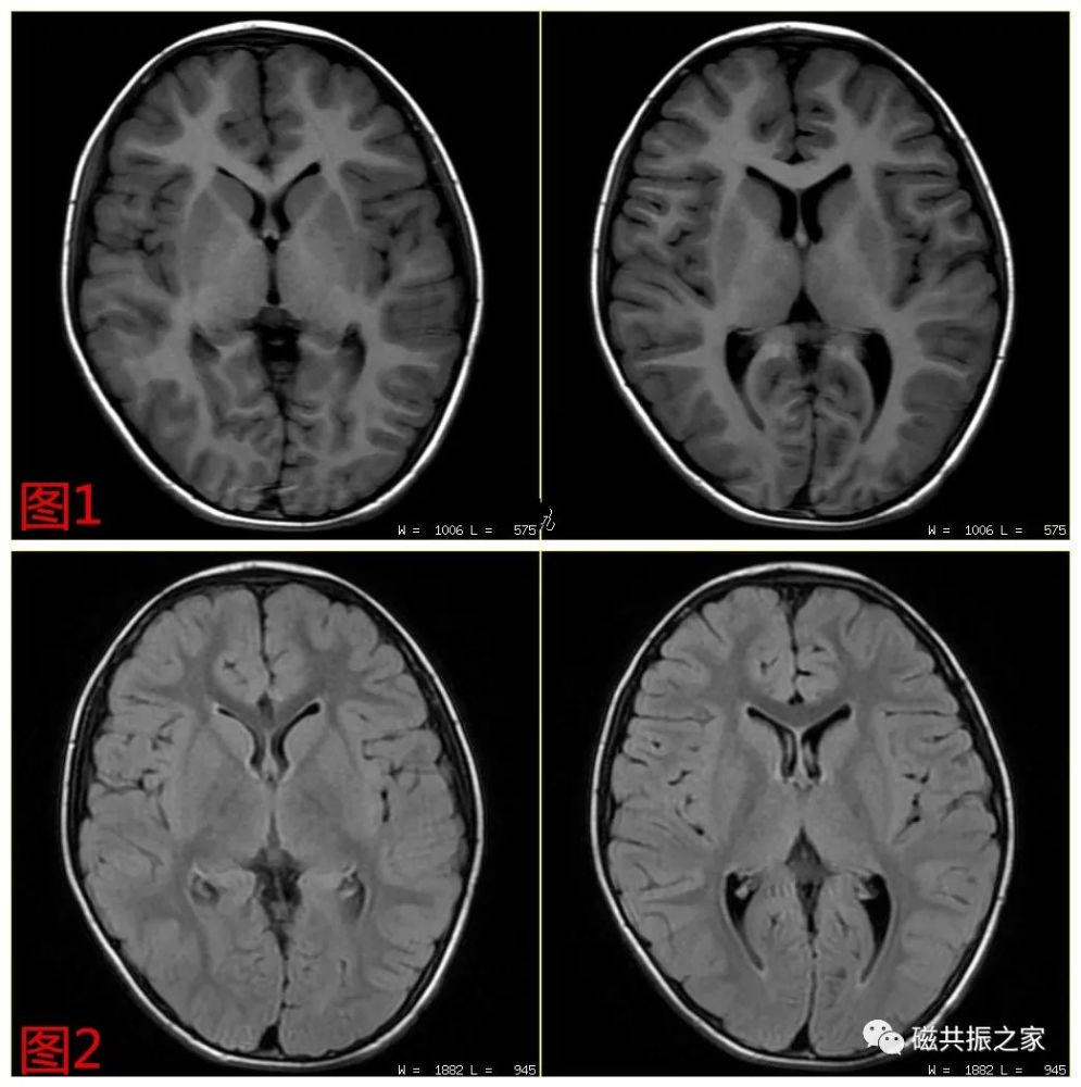 哪个是t2;此时可以看灰白质,成人脑白质在t1wi上白,在t2wi上为灰;灰质