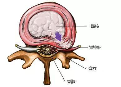 业绩不突出椎间盘却突出了怎么办