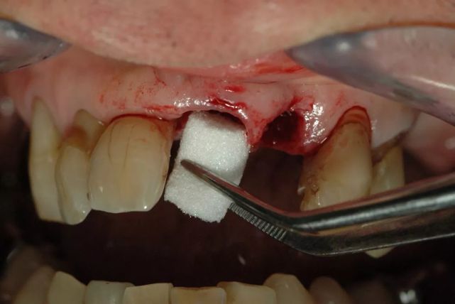 建议进行牙槽嵴保存 桥修复的直接处理 临床病例:拔牙后使用geistlich