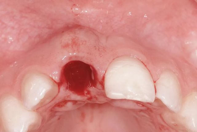 拔牙后不做翻瓣,仔细清除拔牙窝内所有感染的组织.