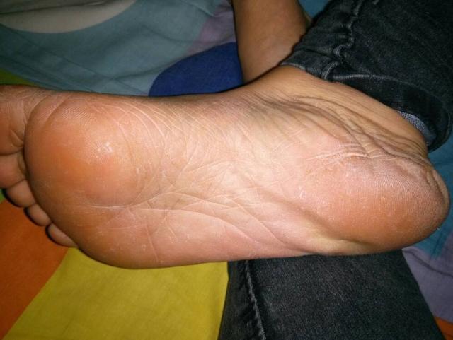 最终呈现在脚底处,此阶段时期的人们脚底会特别的黄