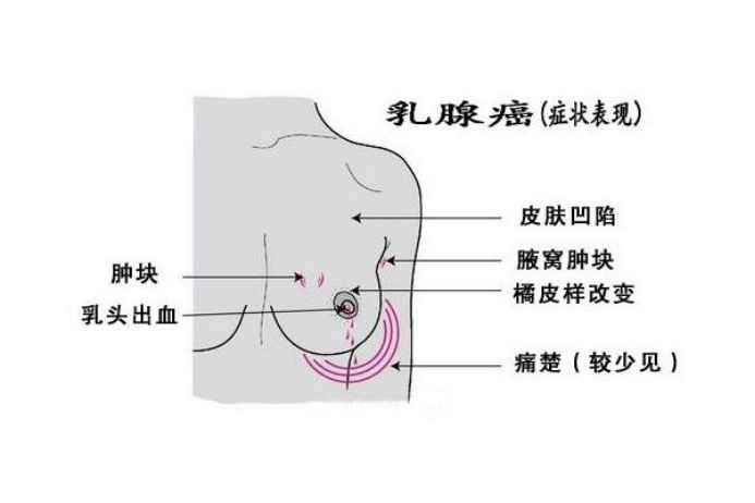 日常生活中怎么保护好乳房,预防乳腺癌呢?