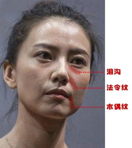 圆圆女神对不起…是灯光太毒三八纹一般是因为软组织松弛下垂,也就是