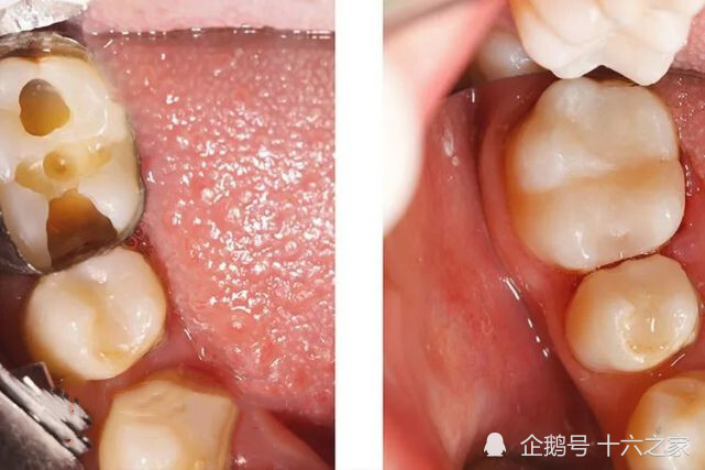 颊舌侧充填体未能恢复牙齿外形的正常突度 突度过小:食物可直接撞击