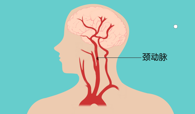 颈动脉有了斑块对哪里影响最大有了斑块后需要注意些什么