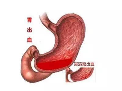 四,烧心:胃粘膜充血,胃酸过多,均会造成烧心的感觉,主要是感觉胃部