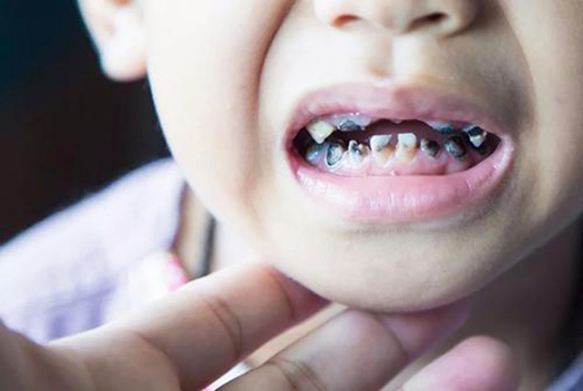 7岁孩子满嘴"烂黑牙",检查后被医生痛批:真是不负责任