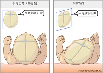 宝宝刚出生时可能就会出现头部外观畸形,这大多是由于产道挤压造成的.