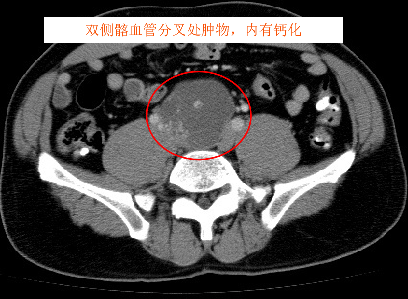 01)ct诊断:直肠癌,肠周lnm,髂血管lnm,肝转移.