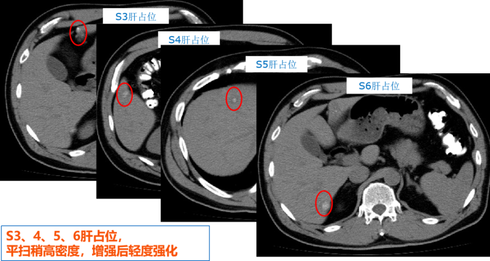 01)ct诊断:直肠癌,肠周lnm,髂血管lnm,肝转移.