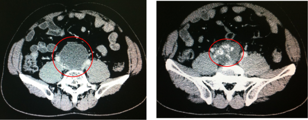 ct 髂血管分叉处肿物无明显变化,内部钙化更明显;2011.9.