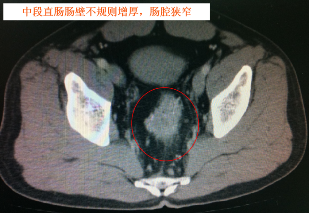 01)ct诊断:直肠癌,肠周lnm,髂血管lnm,肝转移.