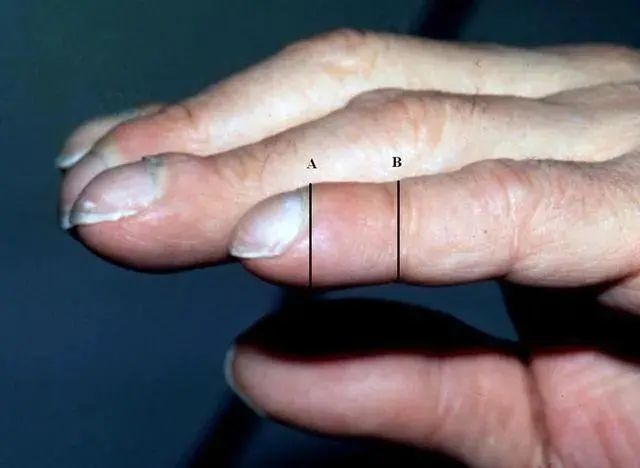 具体表现为手指末端粗大,增生的情况(指甲突出于指甲表面),甚至会伴随
