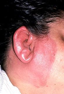 长时间戴口罩戴耳机导致耳朵发红脱皮?一文学会如何应对