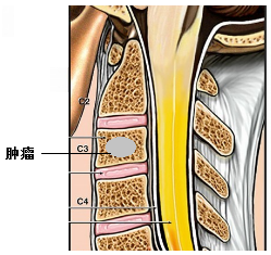 脊柱肿瘤怎么办?