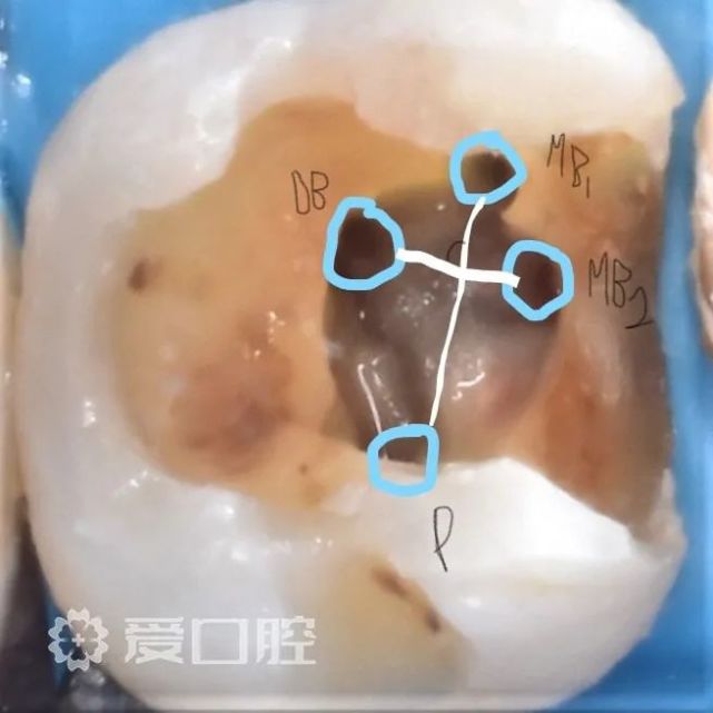 上颌第一磨牙4根管根管治疗1例