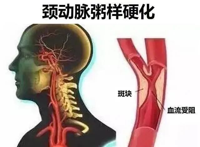 【手术笔记】颈动脉粥样硬化斑块及内膜剥脱手术的配合