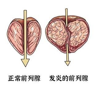 男性前列腺功能下降小便有4个提示信号一物可劲吃炎症不来