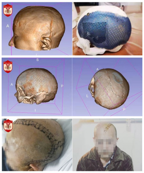 患者颅骨修补时面临感染,切口不愈,钛网外露,头皮坏死的风险比平常大