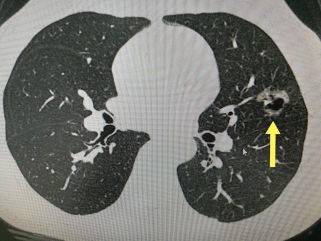 10个人中就有2个发现肺结节,肺结节离肺癌有多远?