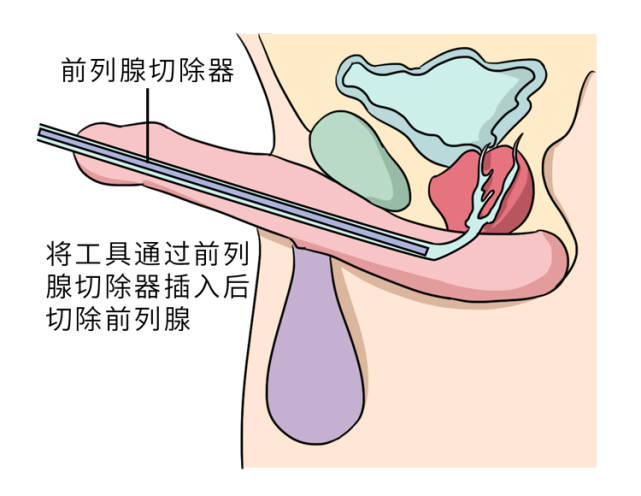 切除前列腺时 有可能会损伤膀胱颈口的括约肌 或者是损伤尿道口的肌肉