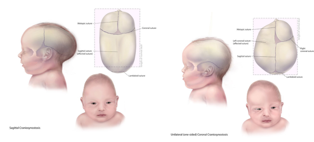宝宝头型异常只是睡扁头吗?一文读懂颅缝早闭的危害