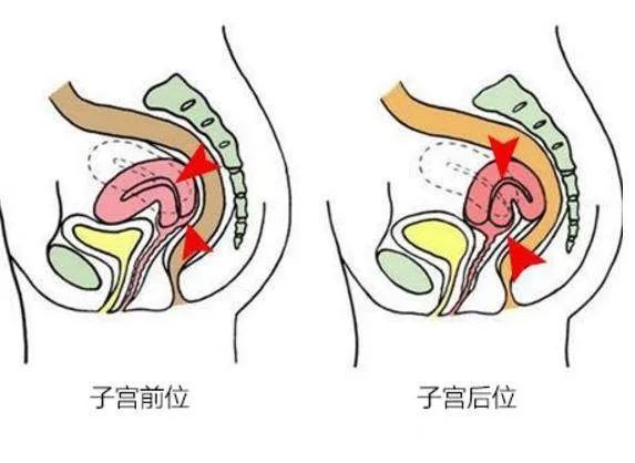 都说子宫前位容易怀孕,是真的吗?兰州天伦不孕专家为你解说