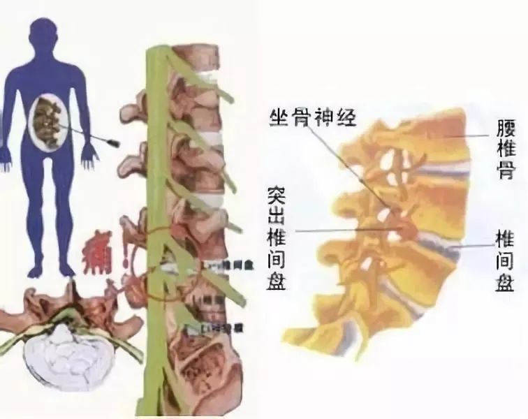 很多人有腰椎间盘突出,由于没有任何症状,还不能称为腰突症